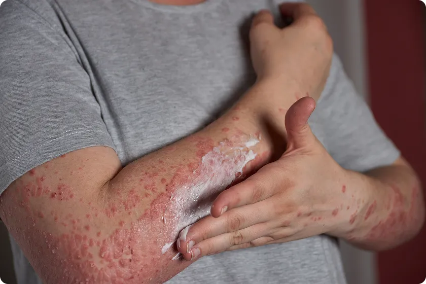 Skin allergy redness with spreading rash on neck signaling early inflammation.