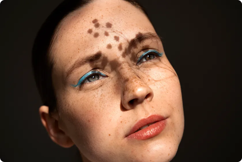 Skin allergy itching with stress rash on face causing visible discomfort.